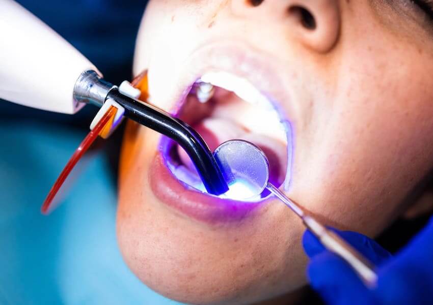 Composite Filling Dental Services | Safe & Durable Care